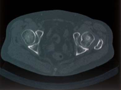 CT-Schichtbild eines Beckens